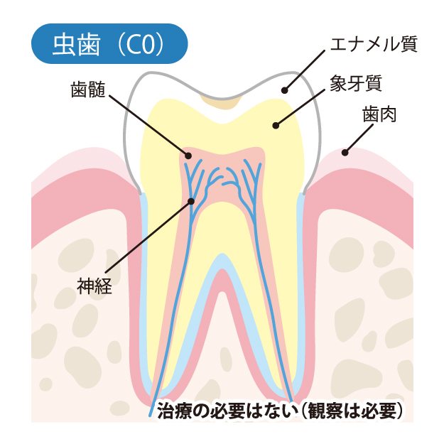 山口県柳井市の歯医者の歯医者、いそべ歯科医院で、むし歯治療