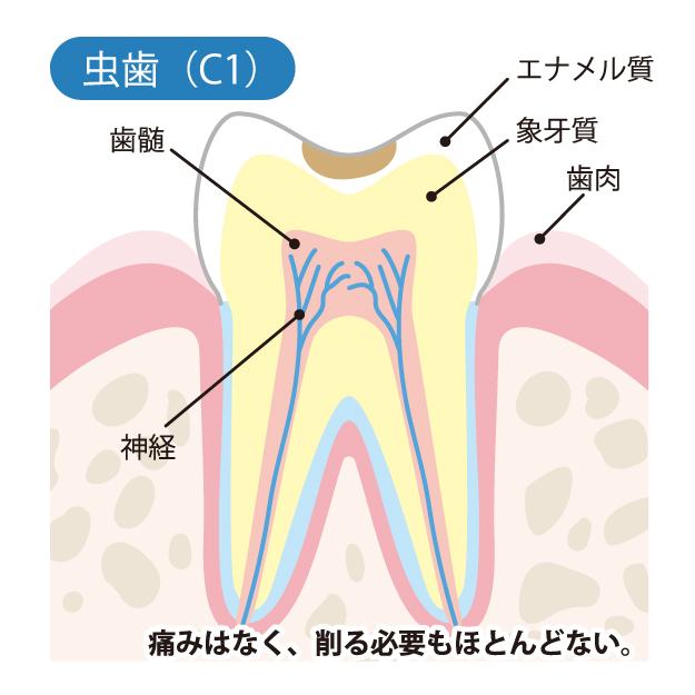 山口県柳井市の歯医者の歯医者、いそべ歯科医院で、むし歯治療