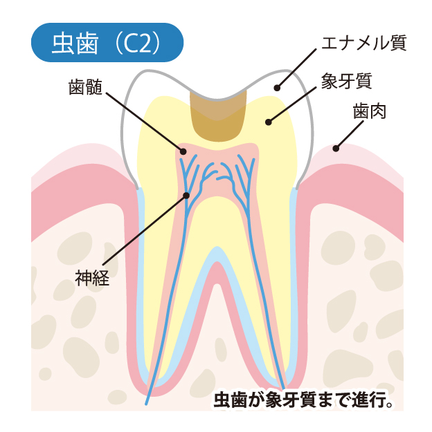 山口県柳井市の歯医者の歯医者、いそべ歯科医院で、むし歯治療