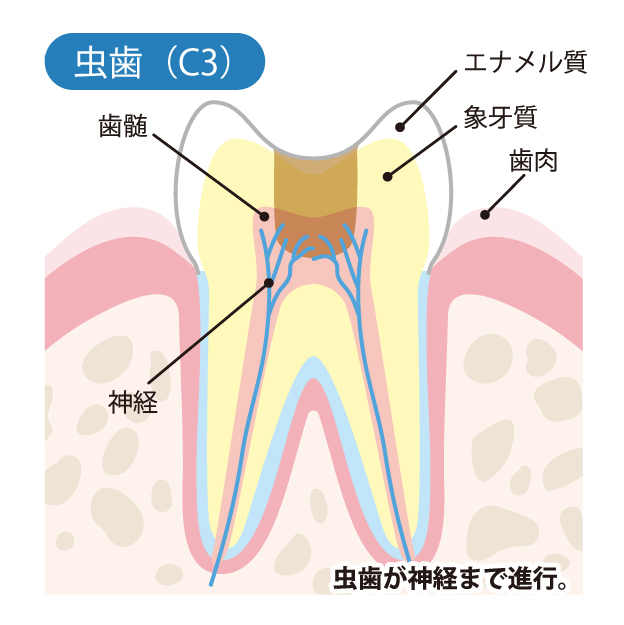 山口県柳井市の歯医者の歯医者、いそべ歯科医院で、むし歯治療