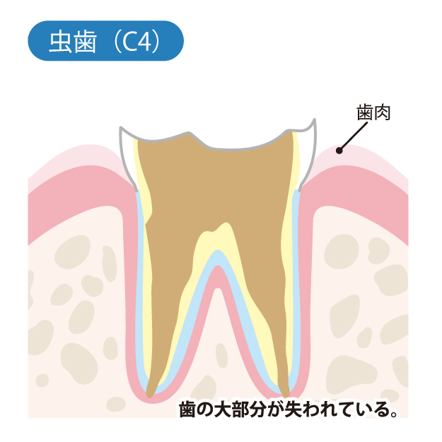 山口県柳井市の歯医者の歯医者、いそべ歯科医院で、むし歯治療