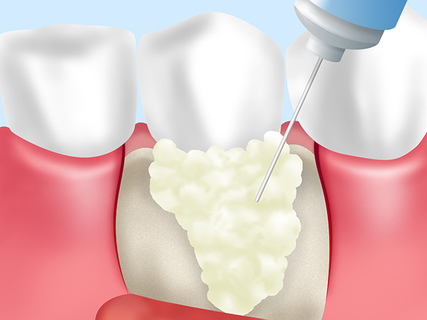 山口県柳井市の歯医者の歯医者、いそべ歯科医院で、歯周組織再生