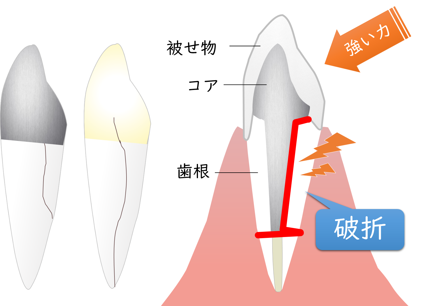 山口県柳井市の歯医者の歯医者、いそべ歯科医院で、根管治療