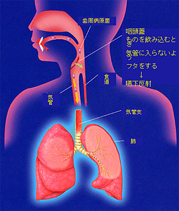 歯周病と肺炎