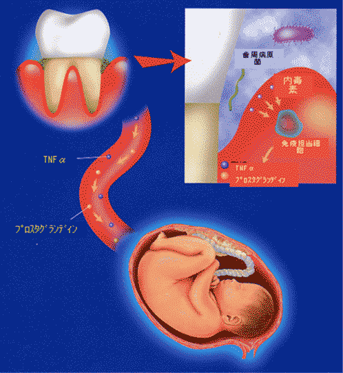 歯周病と早産（低体重児出産）