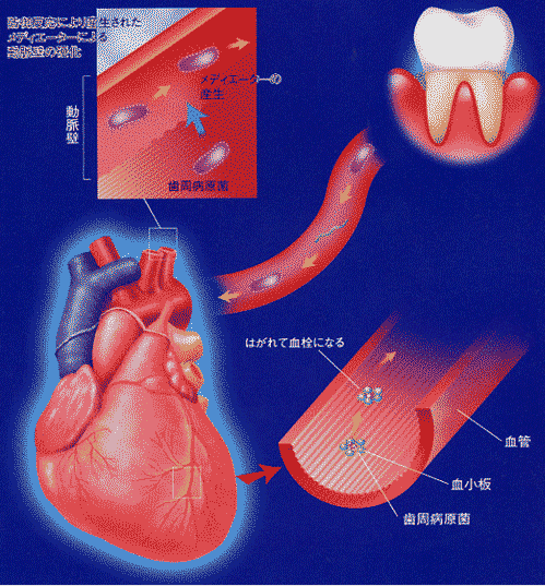 山口県柳井市の歯医者の歯医者、いそべ歯科医院で、歯周病と心筋梗塞の関係説明