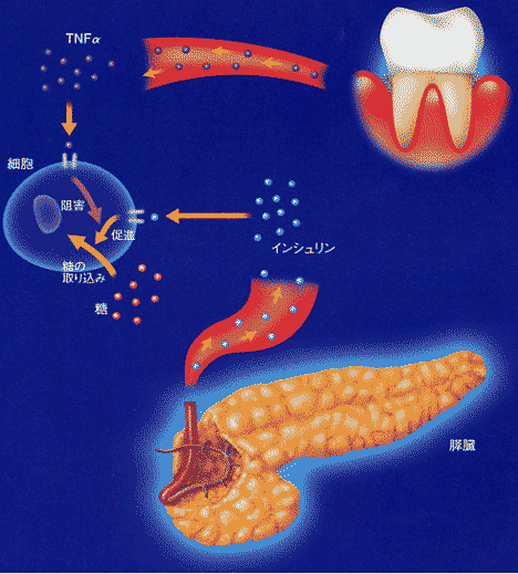歯周病と糖尿病