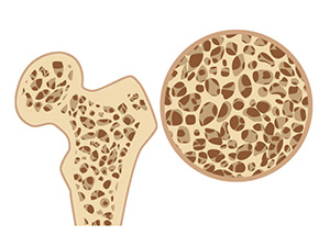 歯周病と骨粗鬆症