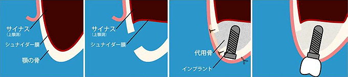 山口県柳井市の歯医者の歯医者、いそべ歯科医院で、インプラント治療