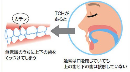 山口県柳井市の歯医者の歯医者、いそべ歯科医院で、歯列接触癖対策